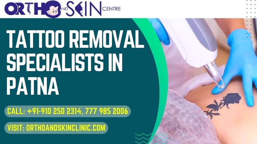 Tattoo Removal Specialists in Patna