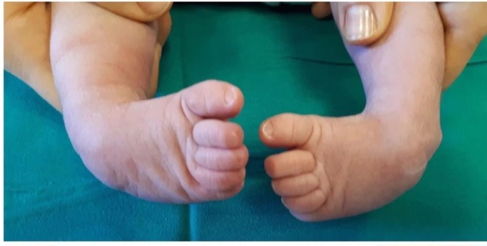 Clubfoot: Symptoms, Causes & Treatment